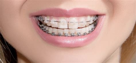 metal brackets brace peabody|Orthodontics .